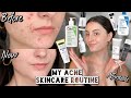 How I Cleared My HORMONAL ACNE & SCARRING with Affordable Skincare | Dry & Sensitive Skin