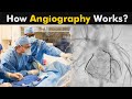 What is Angiography? | How Coronary Angiography works? (Urdu/Hindi)