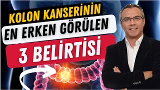 Kolon kanserinin EN ERKEN görülen 3 BELİRTİSİ