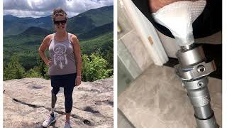 Emily's Recipe: Stoma Care after Osseointegration Amputation Reconstruction