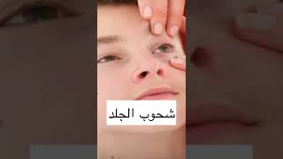 أعراض نقص الحديد