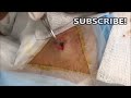 10 Year Old Cyst Popped &amp; Cyst Cupcakes!