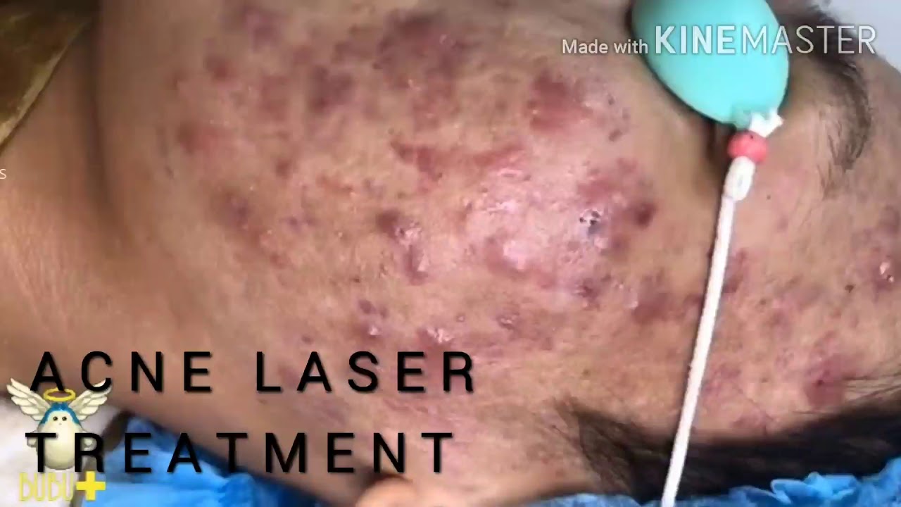 ACNE laser treatment for pimples in indore. Zenith clinic YouTube