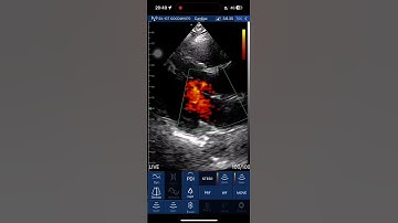 Cardiac Ultrasound with PDI Mode | Tri-scan Max Handheld Ultrasound Machine #pocus