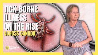 Womans tick bite reveals growing health concern in Canada | #ticks