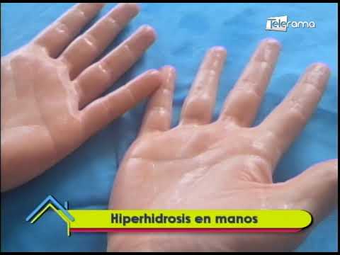 Estética al Día: Hiperhidrosis en manos