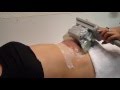 Новейшая система Cryolipolysis™ Z Lipo от Zimmer мирового лидера криотехнологий