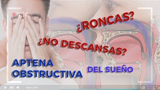 Apnea Obstructiva. #apneaobstructiva #maxilofacial #ronquidos #dormirbien #cirugiamaxilofacial
