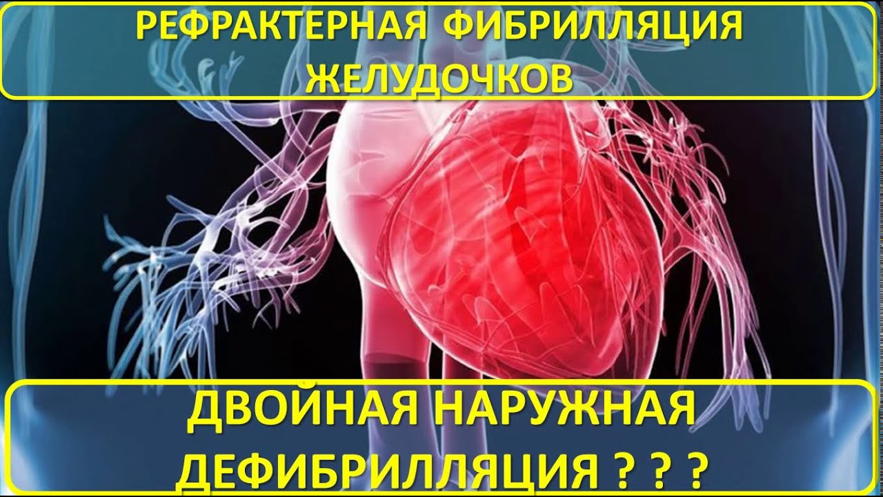 Рефрактерная фибрилляция желудочков и альтернативные режимы ...