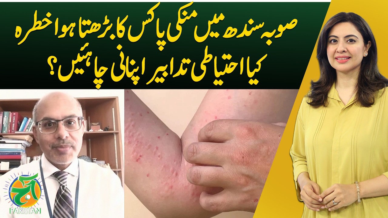Pakistan Rash Monkeypox Sindh Alert | Rising Cases Prevention Tips Pakistan Health ...