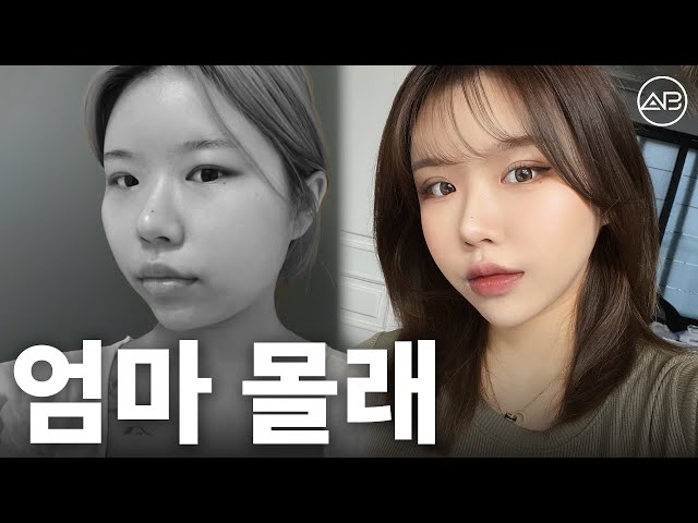 엄마 몰래 성형수술 하기 | 성형비포애프터 | 에이비성형외과
