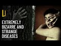The 6 extremely strange diseases you wont believe are real