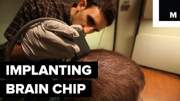 Implanted Brain Chip Restores Hand Movement in Man with Paralysis