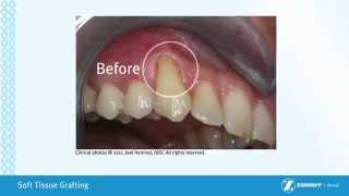 Soft Tissue Grafting For More Cosmetic Dental Implants at Dr. Kim's Honolulu, Hawaii Implant Office screenshot 2