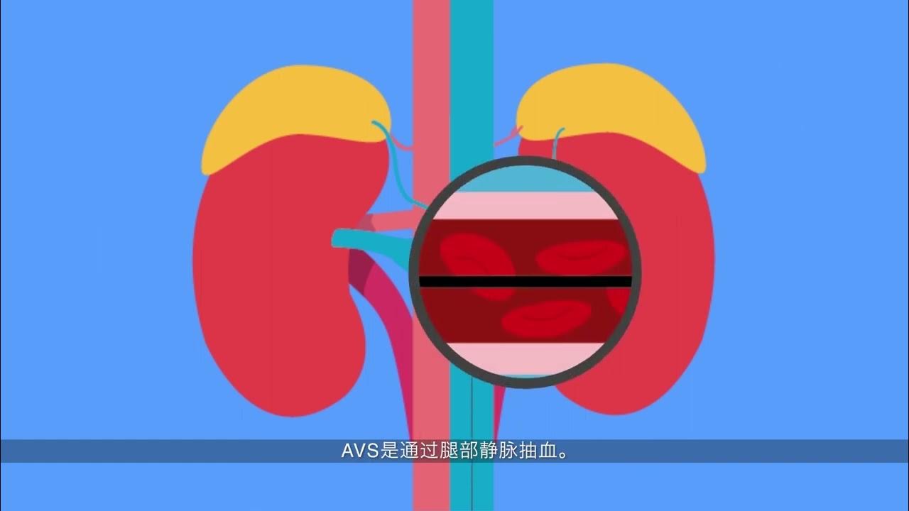 Primary Aldosteronism identifying the abnormal adrenal gland (Chinese