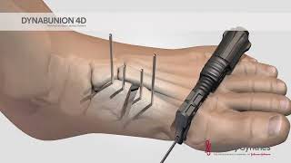 DYNABUNION™ 4D Minimal-Incision Lapidus System - Surgical Animation