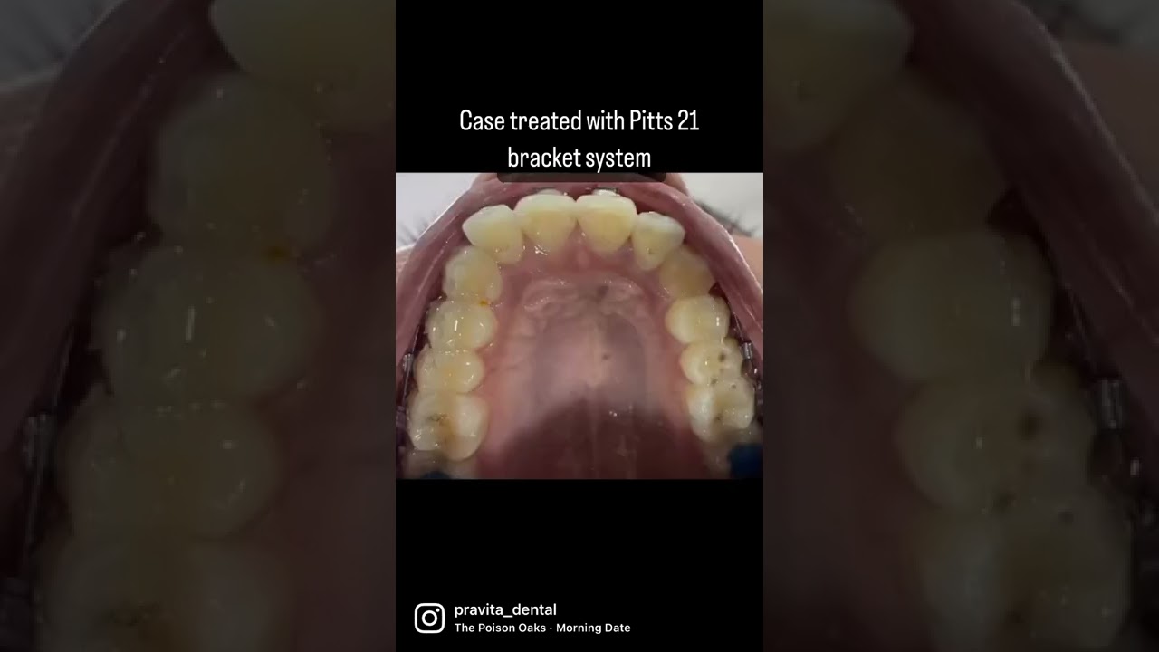Pitts 21 bracket system