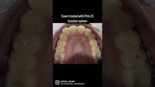 Pitts 21 Bracket System
