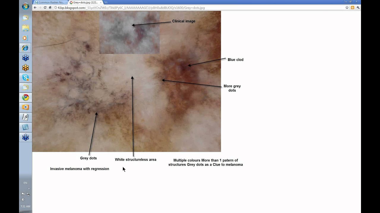 Dermoscopy Made Simple Clues To Melanoma Youtube