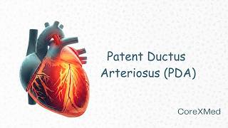 Patent Ductus Arteriosus Made Easy : CoreXMed
