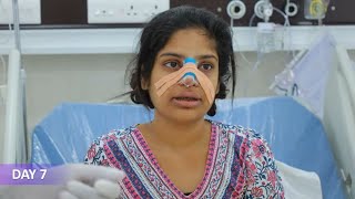 Complete Facial Makeover | Rhinoplasty &amp; Lip Reduction Surgery