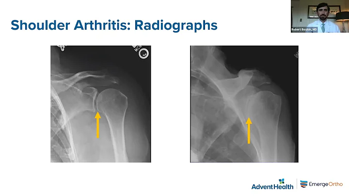Advanced Treatment for Shoulder Arthritis  Robert ...