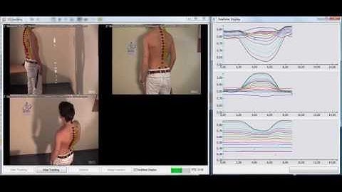 Spine Analysis in Real Time and 3D - with Simi Motion