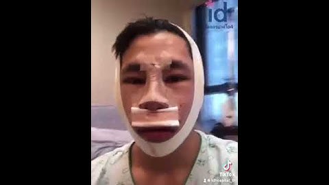 รีวิวศัลยกรรมผู้ชาย : เสริมจมูก ผ่าตัดโครงหน้า ที่เกาหลี Male Plastic Surgery in Korea