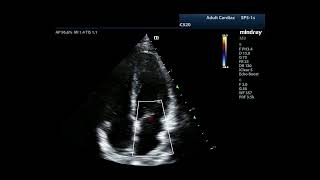 : How to...Measure MR Vena Contracta