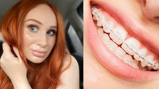 Ceramic braces | CLEAR braces! How I feel about them screenshot 5