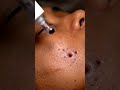 Clinic-Grade Pore Vacuum Extractions — Satisfying &amp; Clean” #asmr #skincare #macroskin #satisfying