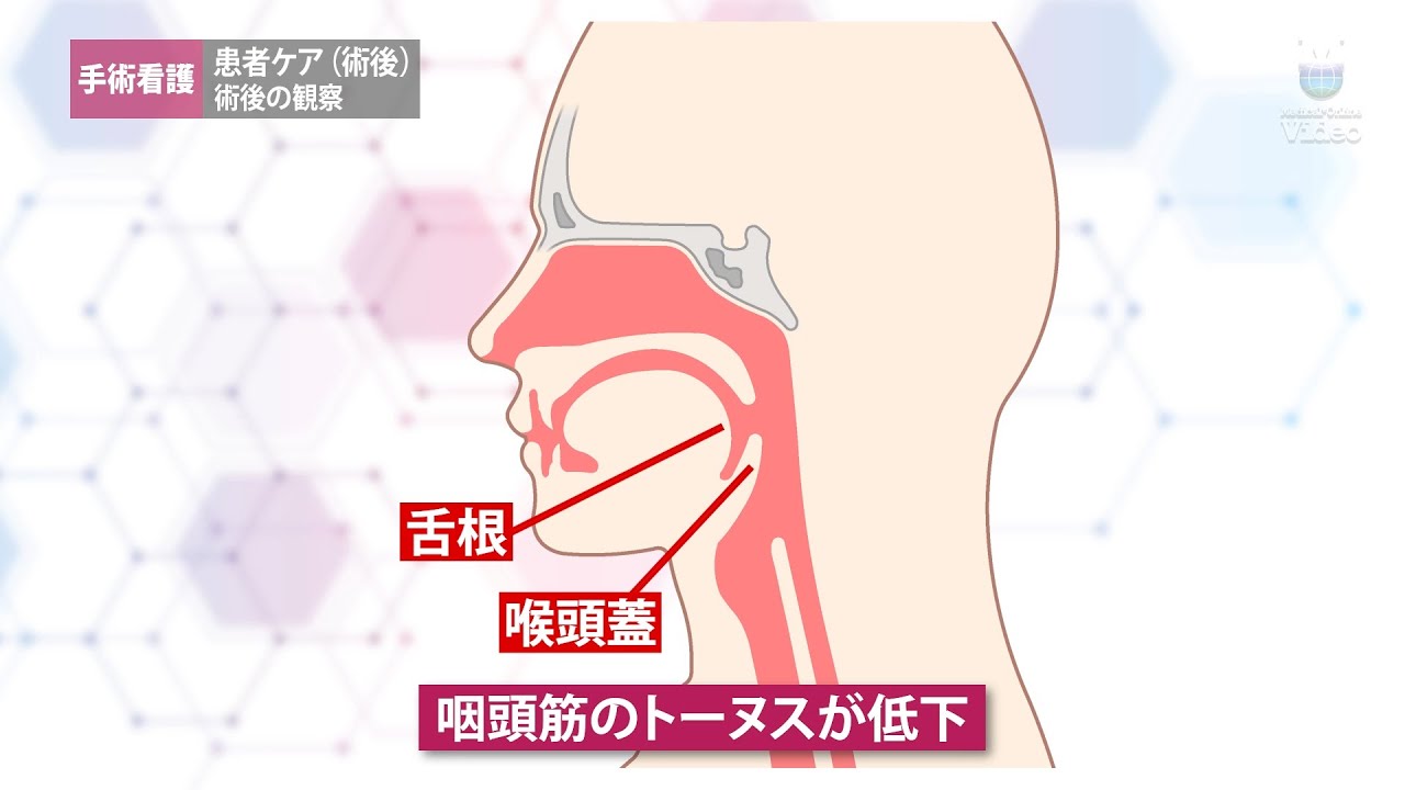 【中古】 手術患者のケア 患者ケア（術後） 術後の観察 ｜ Medical*Online Video
