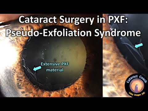 Secrets to Cataract Surgery in eyes with Pseudo-Exfoliation Syndrome