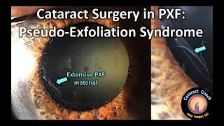 Secrets to Cataract Surgery in eyes with Pseudo-Exfoliation Syndrome