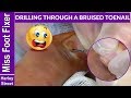 Drilling through a toenail with cherry juice like liquid trapped under it