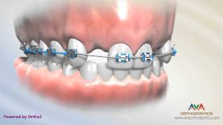 Orthodontic Treatment for Missing Lateral Incisor - Haley Retainer with Fake Teeth