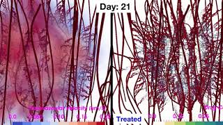 In-silico cancer drug delivery modelling (chemotherapy; injection @day 10)