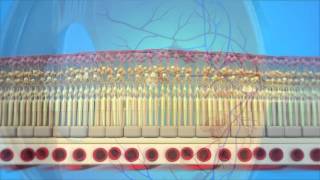 Macular Edema Cystoid Macular Edema Retina Oftalmo Ophthalmology Oftalmologia Oftalmolog A Ophtalmologie