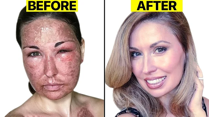 Fractional CO2 Laser: 20 Questions You NEED Answer To