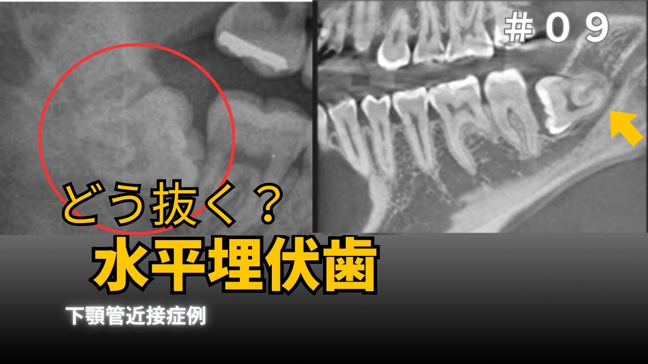 埋伏歯抜歯】case9：どうやって抜く？右下水平埋伏歯 Impacted