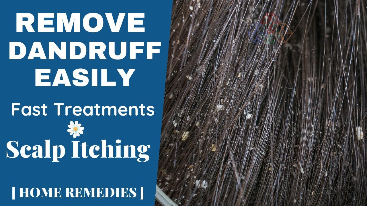 How to remove dandruff from hair at home permanently. Clean dandruff