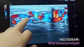 Varikosel İlerler Mi? Varikosel Takiplerinin Önemi Ergenlik Çağı Varikosel 10 Yıl Sonrası Etkileri