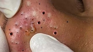 Relax Every Day With Treatment Satisfying blackhead relaxing acne, pimple, cyst by FISHING VIDEO 92 views 1 year ago 4 minutes, 44 seconds