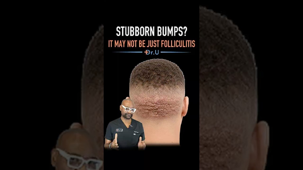 Persistent Hair Transplant Bumps? It May Not Be Just Infection