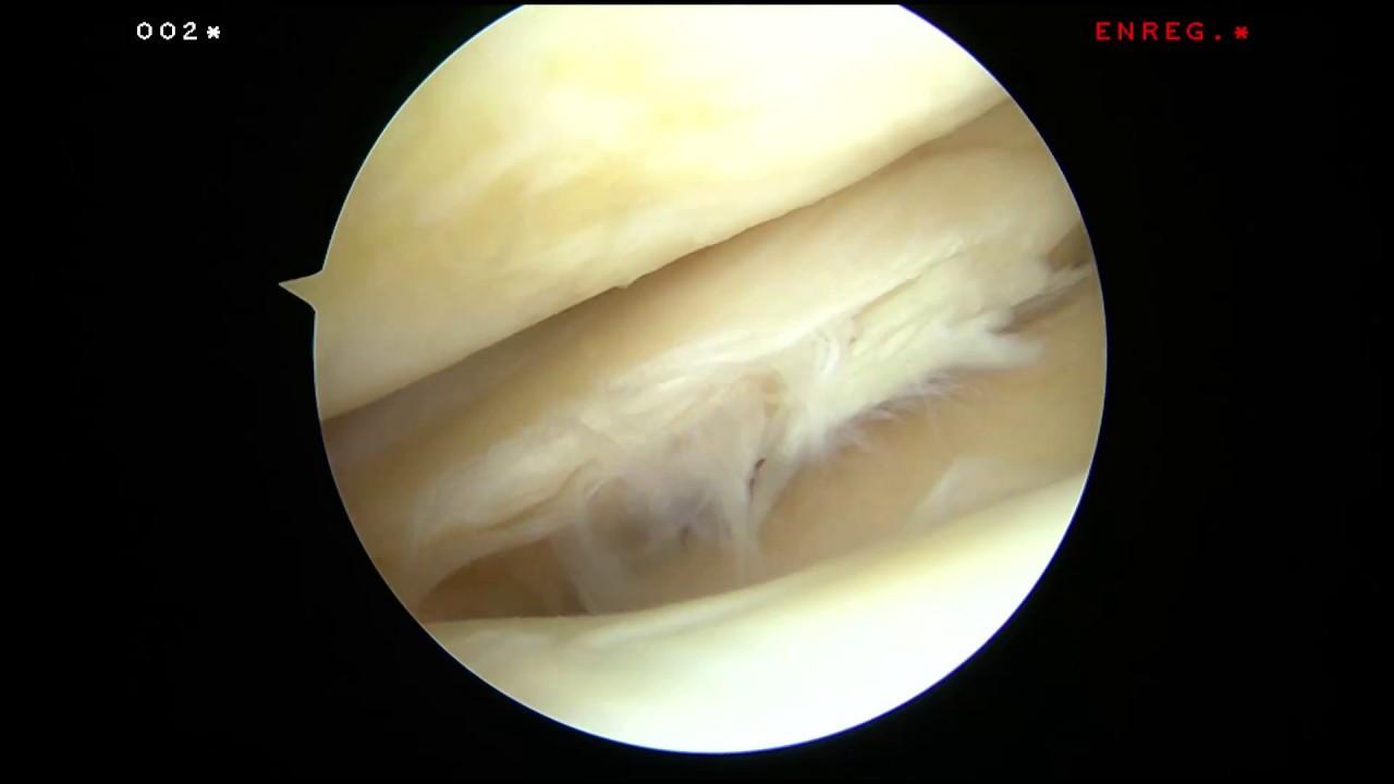 Arthroscopie du genou, anse de seau du ménisque externe Dr