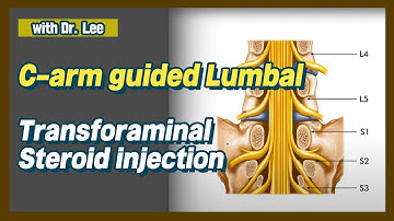 lumbar  L5 transforaminal, L5-S1 facet joint injection: C arm, lecture & clinical case