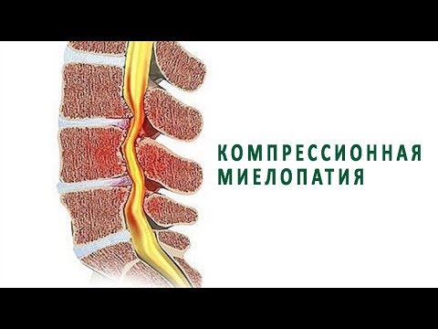 Что нужно знать о компрессионной миелопатии