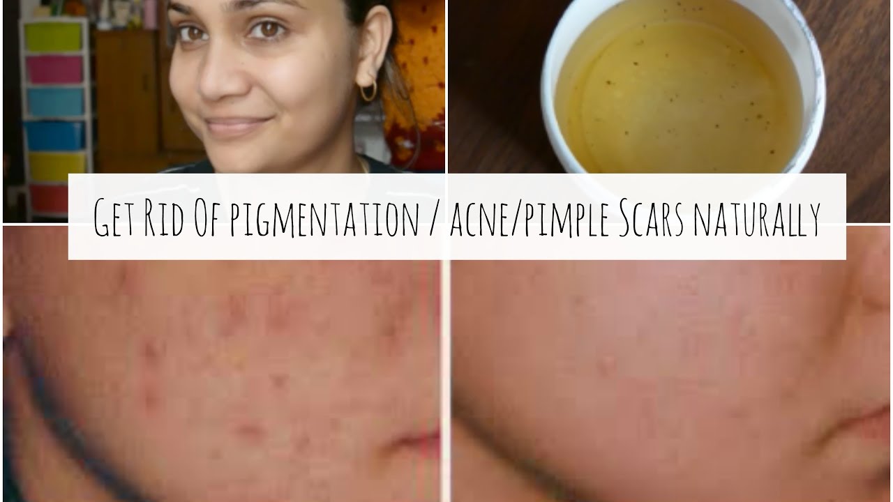 acne pock mark removal