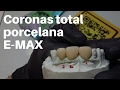 Coronas Dentales EMax TOTAL PORCELANA👅PASOS para Cementación/Adhesión #CoronasDentales