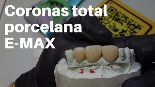 Coronas Dentales EMax TOTAL PORCELANAPASOS para Cementación/Adhesión #CoronasDentales